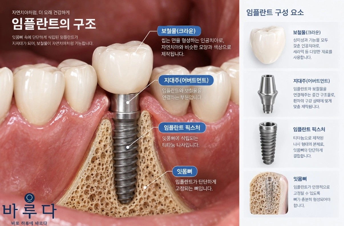 임플란트 구조