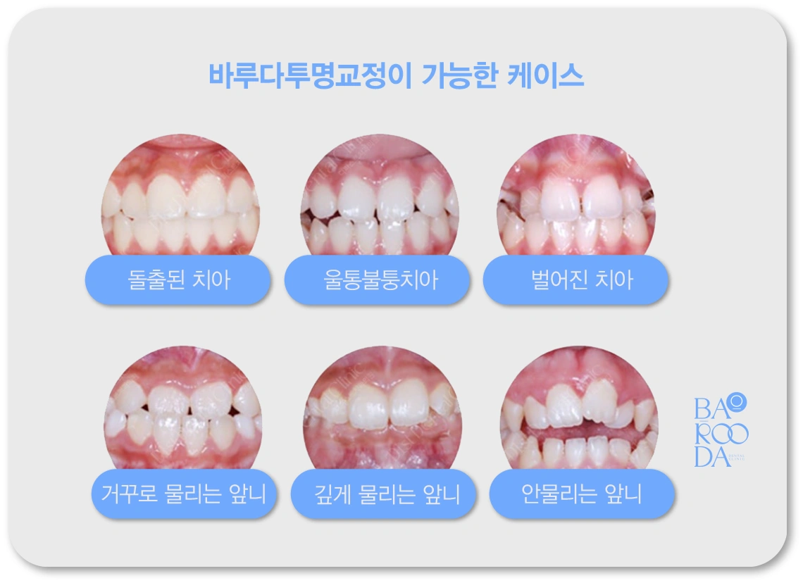 투명교정케이스