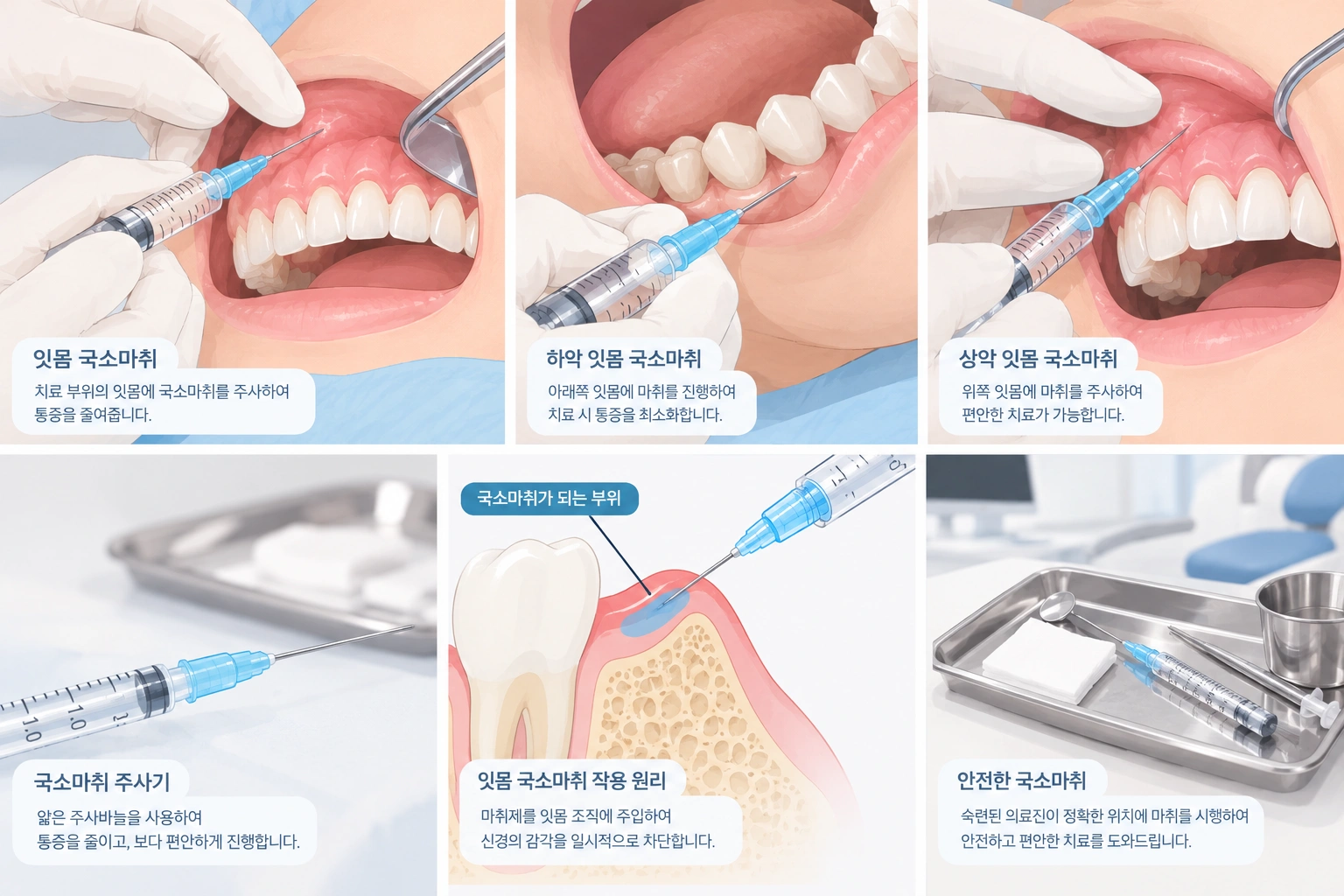 국소마취