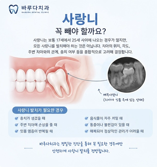 사랑니설명