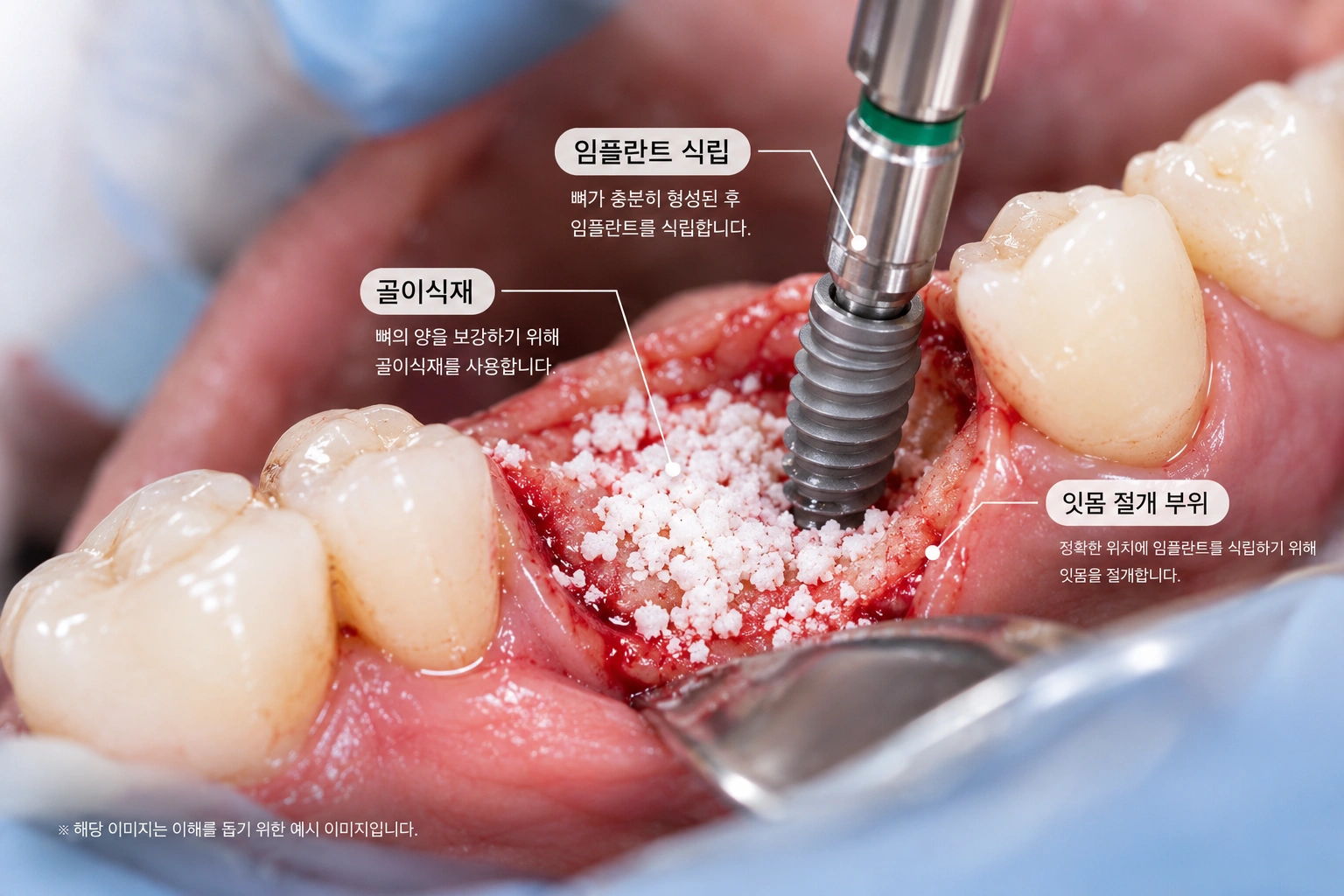 뼈이식사진
