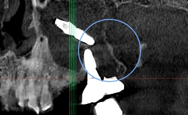 기존 임플란트 제거 전 파노라마