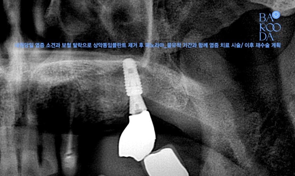 기존 임플란트 제거 후 파노라마
