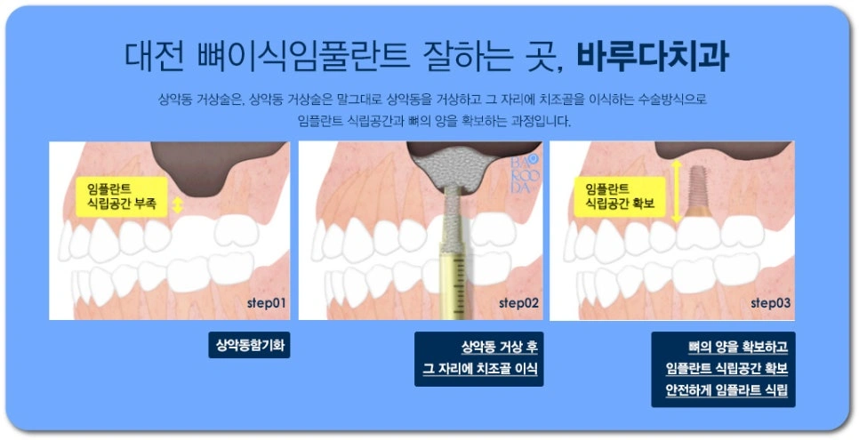 상악동거상술 과정