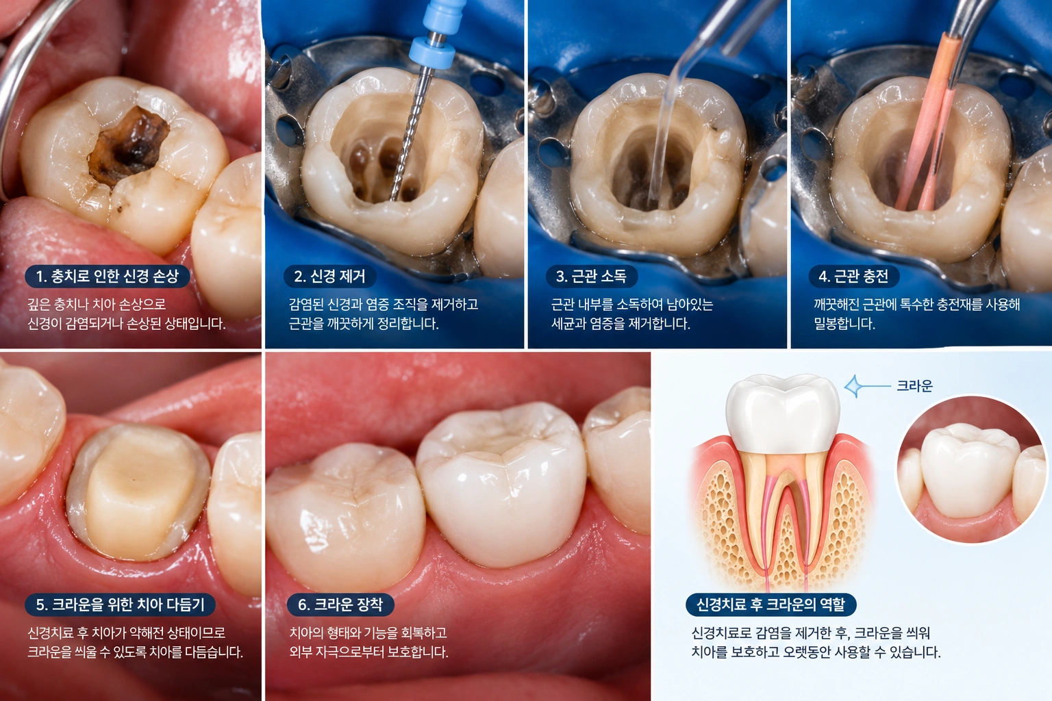 신경치료 치료과정