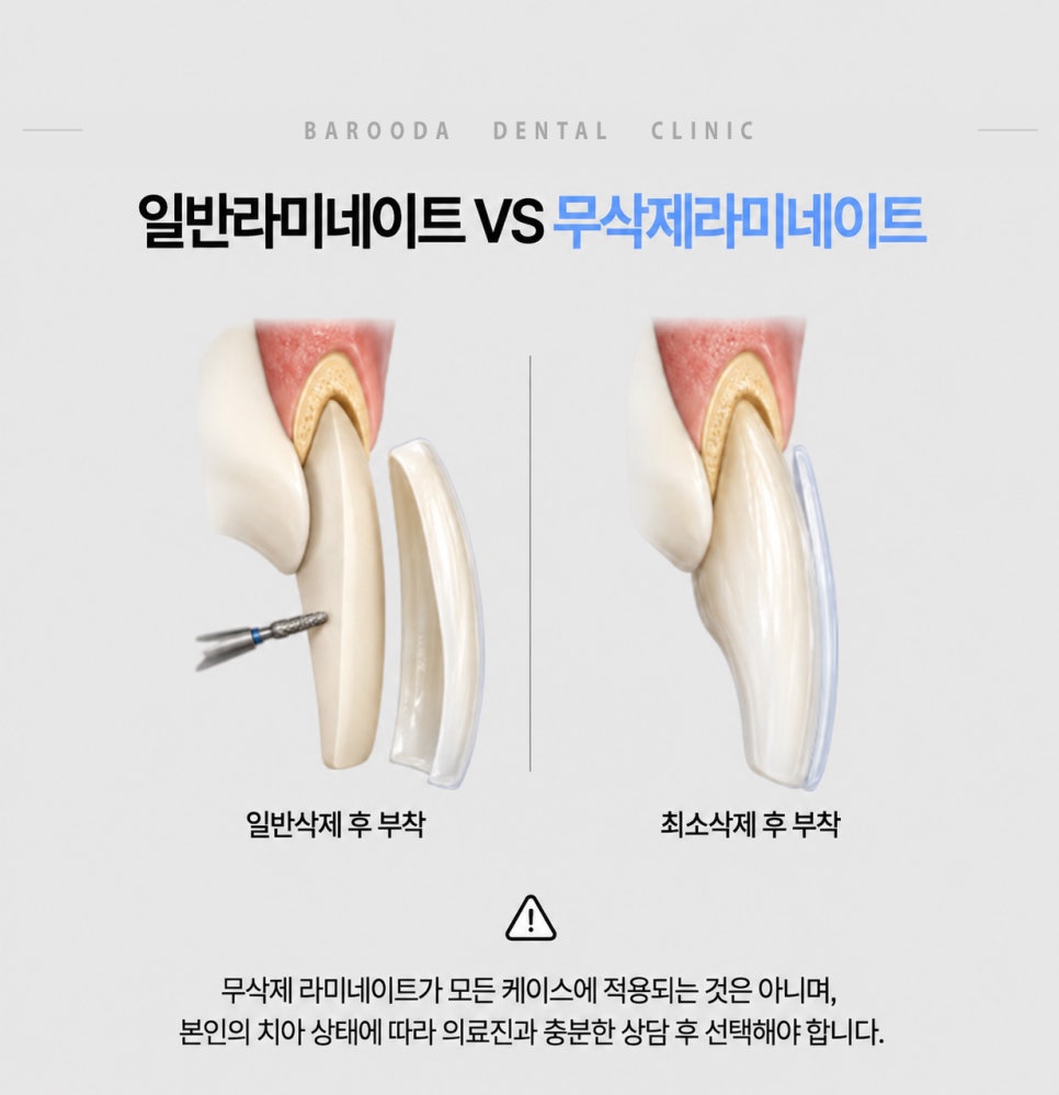 라미네이트 차이