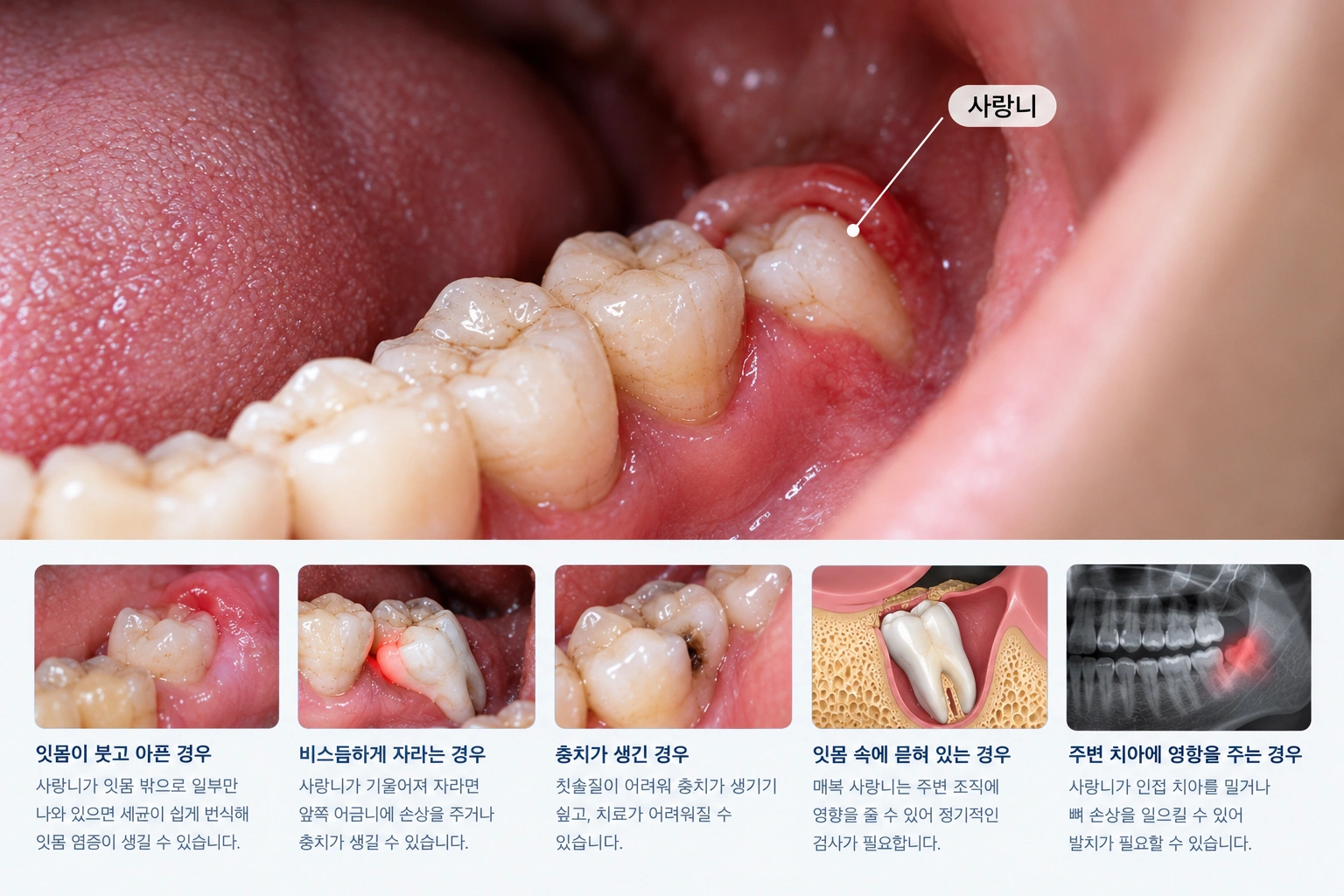 사랑니 무조건 발치해야 할까요?