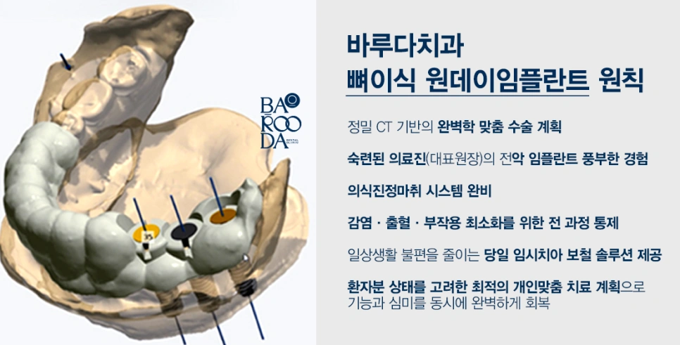 발치 후 바로 임플란트 가능할까요? - 바루다치과의원