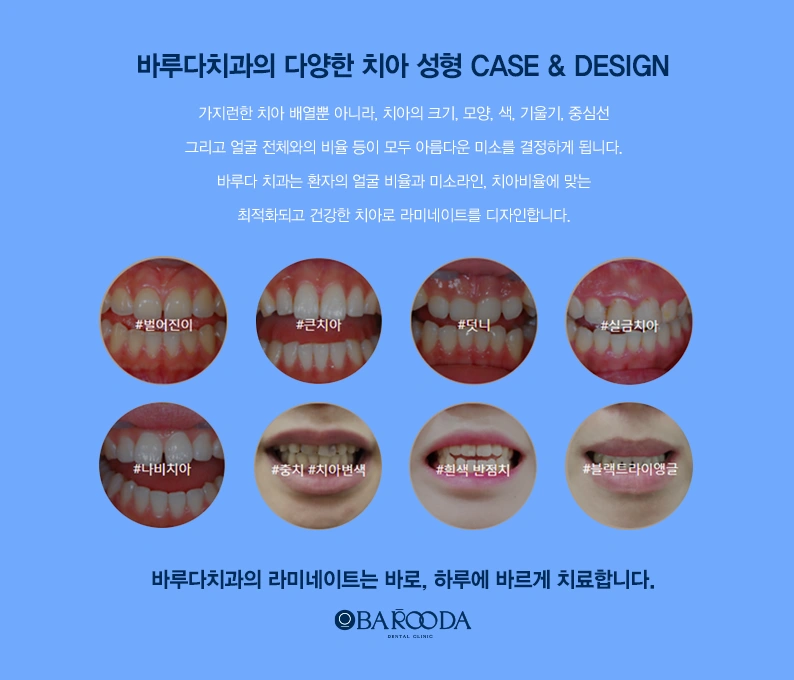 라미네이트, 치아를 얼마나 삭제해야 할까요? 자연치아를 고려한 최소삭제 라미네이트