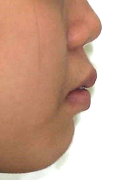 B. 얼굴 측면 전후사진 · 증례 01 · 치료 전