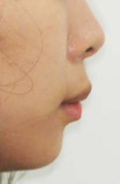 B. 얼굴 측면 전후사진 · 증례 10 · 치료 전