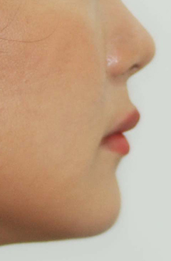 B. 얼굴 측면 전후사진 · 증례 06 · 치료 후