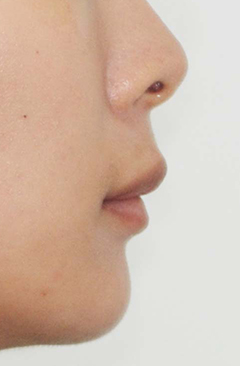 B. 얼굴 측면 전후사진 · 증례 10 · 치료 후