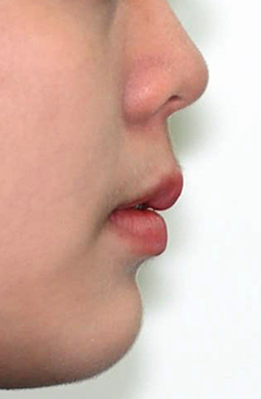 B. 얼굴 측면 전후사진 · 증례 01 · 치료 후