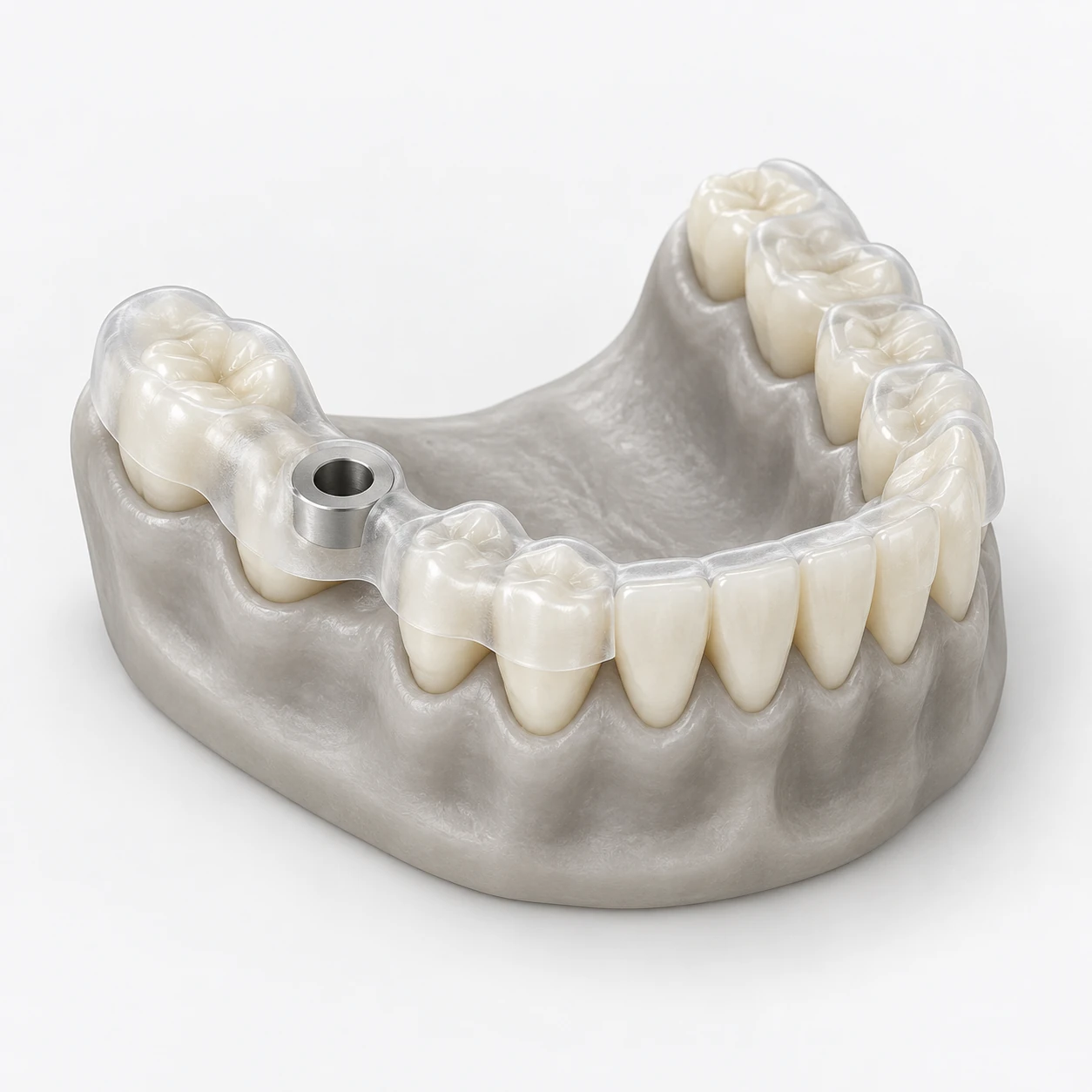 치열 위에 장착한 투명 수술용 가이드와 가이드 슬리브 모형 (설명용 3D 일러스트)